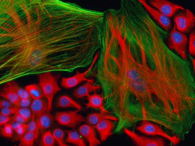 Our understanding of the role of the tumor microenvironment in the development and progression of lung cancer remains rudimentary. The Jacks Lab wants to determine whether the stroma contributes to tumor progression, as insights into the interactions between tumor and stromal cells may provide new opportunities for more focused therapeutic strategies. Immunofluorescent image using two different stromal-specific antibodies (in red and green) and a nuclear stain (in blue).