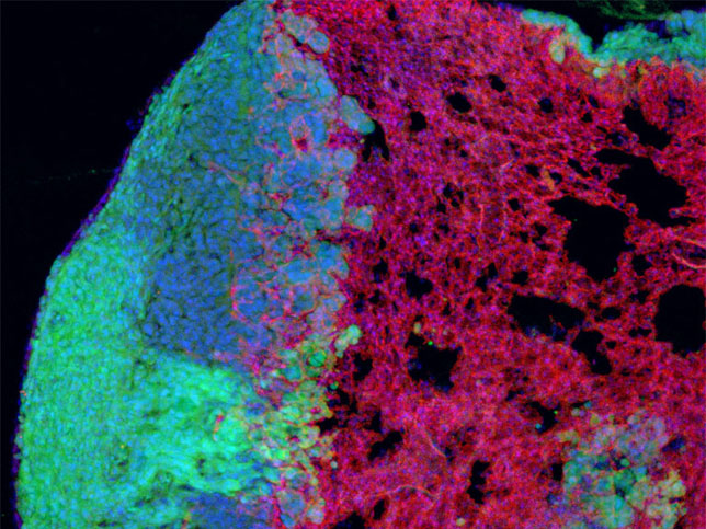 Tumors require large amounts of oxygen and nutrients to fuel their rapid growth. How do they acquire these resources? Here, a lung tumor (green) extends to the right, infiltrating healthy lung tissue, rich in nutrient-carrying blood vessels (red). The Jacks Lab is interested in understanding the nature of the communication between cancer cells and blood vessels.